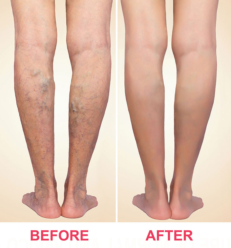 Laser-Therapy-For-Varicose-Veins