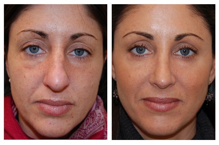 Photofacial-Treatment