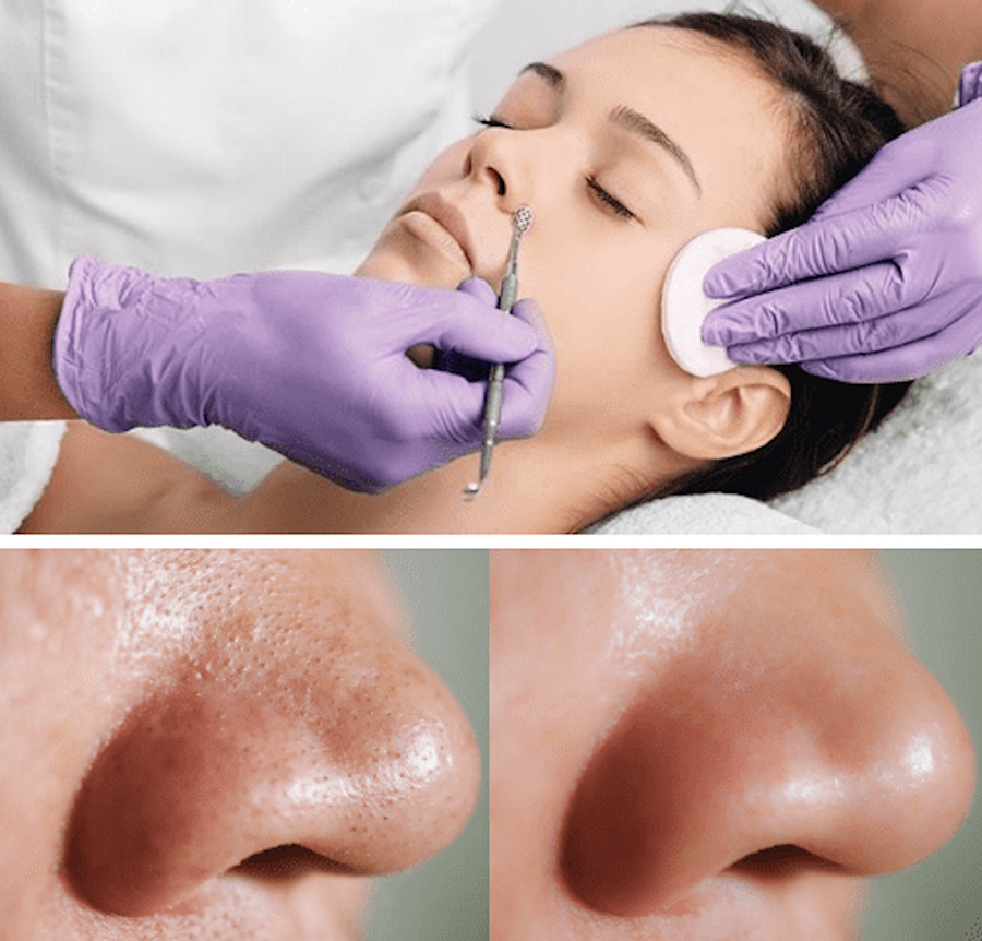 deep-pores-facial-treatment